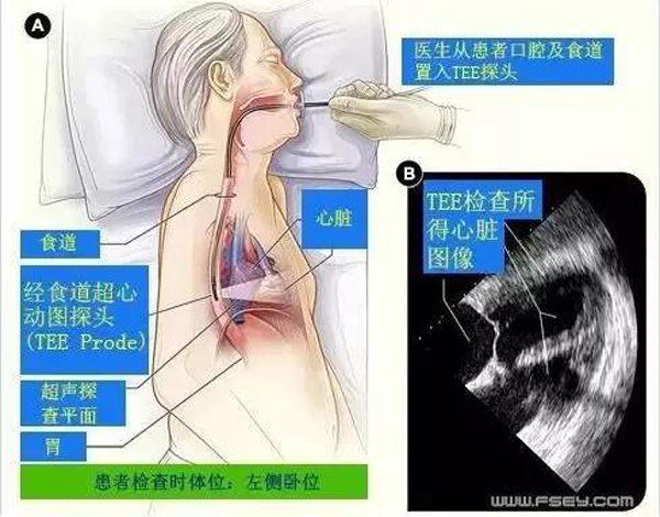 和平医院率先开展长治地区经食管超声心动图检查