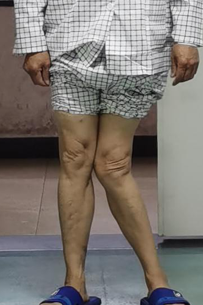 患者李某,左膝严重外翻畸形,达到45度,站立时呈"k"型腿,走路"一摇三